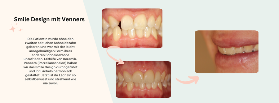 Smile Design
